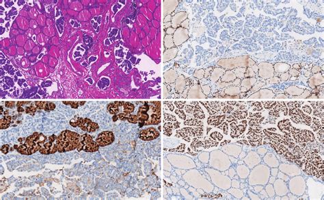 Histological And Immunohistochemical Results Of The Tumor A