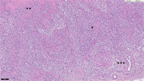 Histology Of An Nkt Cell Lymphoma Showing Extensive Lymphocytic