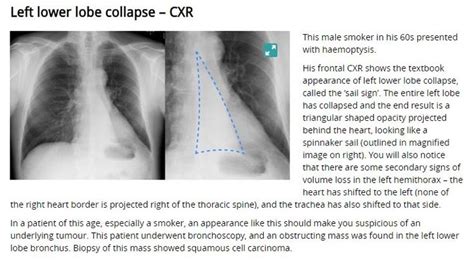 Atelectasis Left Lower Lobe Radiology X Ray Lower