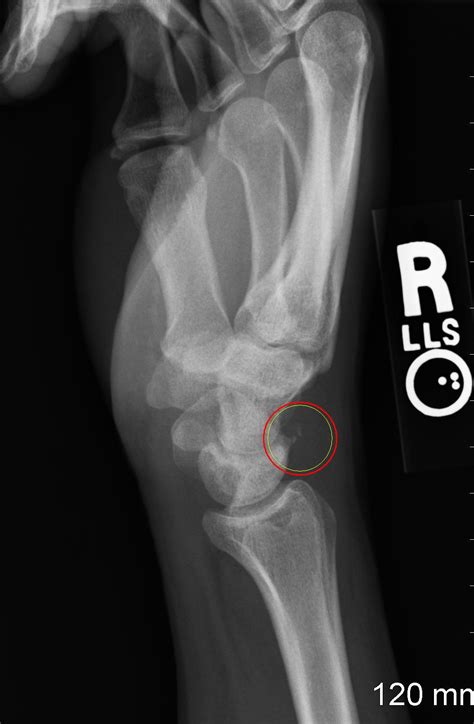 Avulsion Fractures :: Bone Fracture & Repair