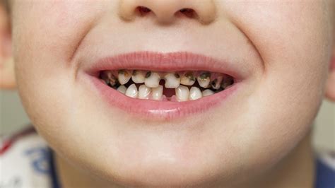 What Causes Childrens Cavities And How To Avoid Them Scottsdale