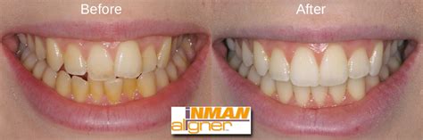 What to do immediately following your dental procedure. Inman Aligner | Teeth Straightening | Adult Braces ...