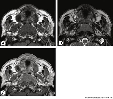 Primary Mantle Cell Lymphoma Of The Nasopharynx A Rare Clinical Entity