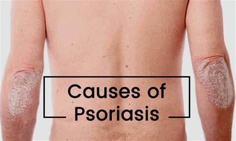 Psoriasis Causes Symptoms Types And Treatment Health Blog