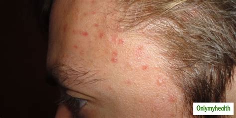 It is typically a secondary sex characteristic of human males. Hairline Acne: What Is This and How This Can Be Treated