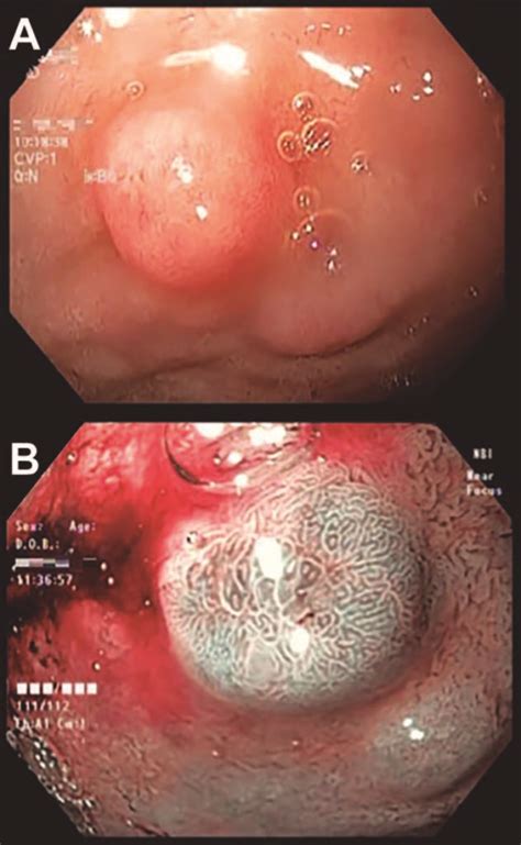 A carcinoid tumor is a type of neuroendocrine tumor that usually develops in the digestive (gi) tract (such as the stomach or intestines) or in the lungs. Disección endoscópica submucosa de tumor neuroendocrino primario de duodeno. Reporte de caso y ...
