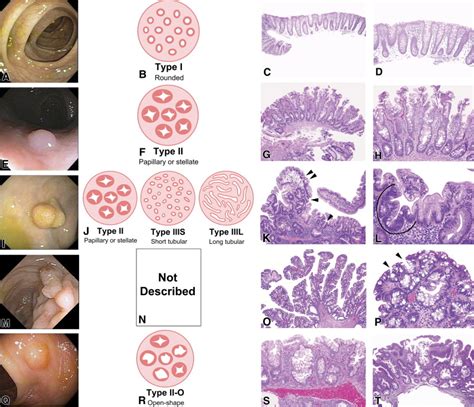 The Cutting Edge Of Serrated Polyps A Practical Guide To Approaching