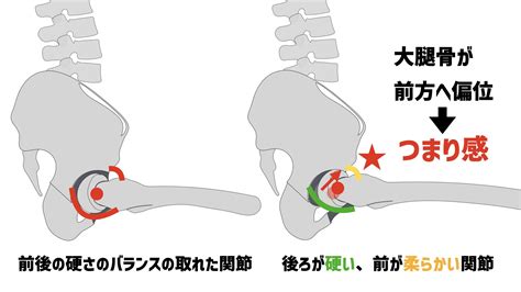 ユウスケ 筋トレ怪我ケガゼロプロジェクト On Twitter 【股関節のつまり感】 大腿骨頭が前方へ偏位する1つの要因として、前後の軟部組織の硬さのアンバランスがある 後方が硬く