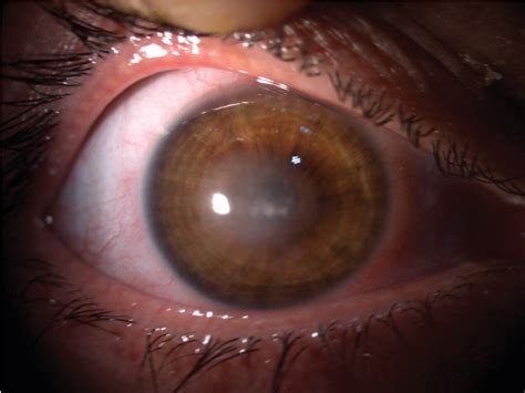 Figure 2 From Contact Lens Related Corneal Ulcer Caused By Klebsiella