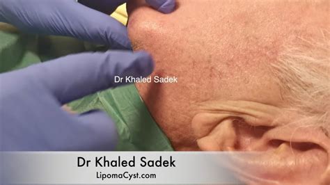 Massive Face Cyst Dr Khaled Sadek Lipomacystcom Youtube