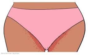 When it comes to preventing ingrown hairs, your two main categories of prevention, according to freiman, are mechanical and chemical. How to Avoid Razor Burn & Ingrown Hairs. in 2020 | Ingrown ...