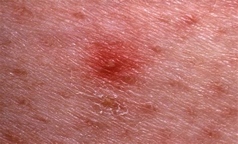 Early Lapatinib Induced Skin Rash Predicts Better Survival With