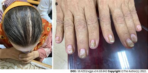 Share More Than 116 Alopecia And Nail Dystrophy Treatment Latest