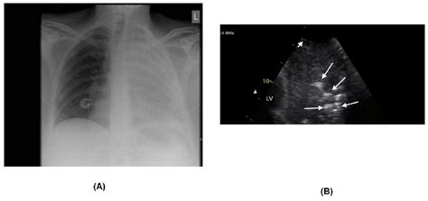 Chest X Ray And Ultrasound Of Patient 1 A Chest X Ray Showing