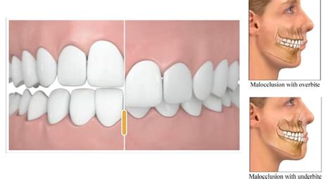 An overbite is a structural problem. Overbite, Underbite…What Is This All About? - Holmdel ...