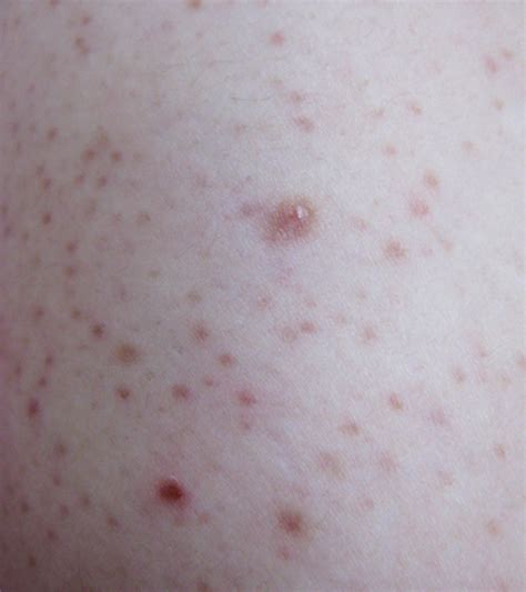 Chicken Skin Keratosis Pilaris Causes Treatment And