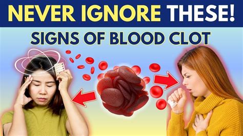 8 Warning Signs Of Blood Clots You Shouldnt Ignore Life Saving Tips
