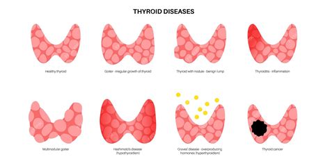 Premium Vector Thyroid Gland Diseases Cancer Thyroiditis Goiter