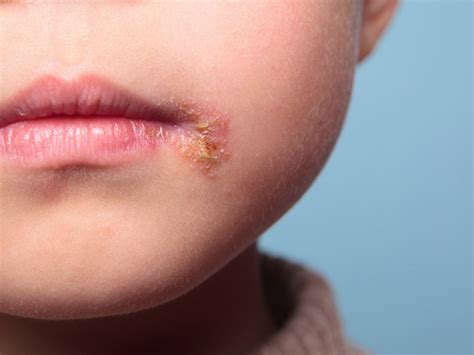 Impetigo Bolhoso Em Adulto