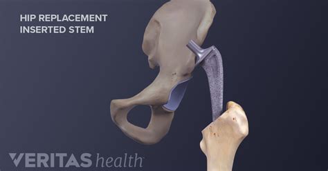 Minimally Invasive Hip Replacement Vs Traditional Hip Replacement