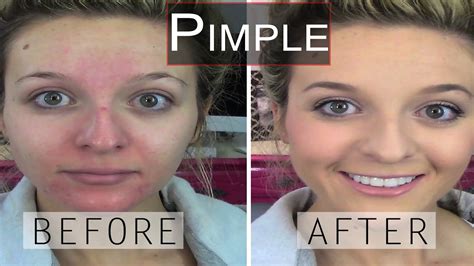 Home Remedies To Reduce Pimple Redness How To Remove Pimples