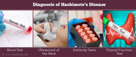 Hashimotos Thyroiditis Risk Factors Types Causes Symptoms