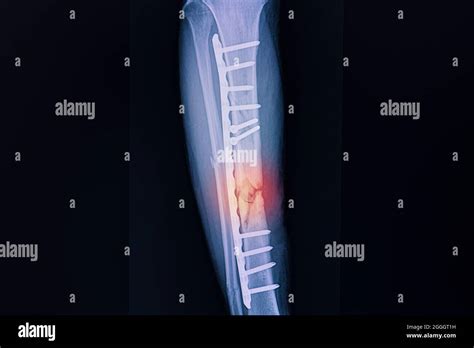X Ray Firm Of A Patient With Fracture Of Right Tibia After Surgical