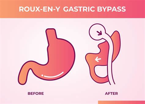 Roux En Y Gastric Bypass Rny Weight Loss Surgery Vector Illustration Icon 14818796 Vector Art At