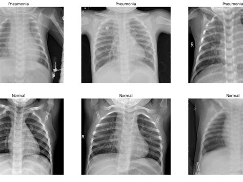 Identifying Viral And Bacterial Pneumonia From Chest X Ray
