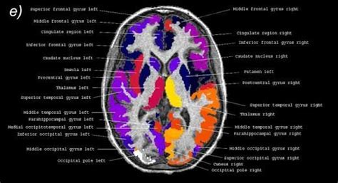 Image Result For Axial Mri Thalamus Brain Anatomy Human Brain