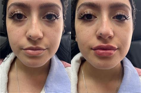 Dermal Fillers Before And After Photo Gallery Sacramento Ca
