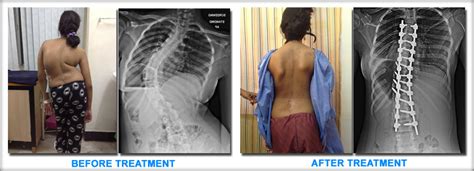 Spine Surgery Salem Spinal Deformity