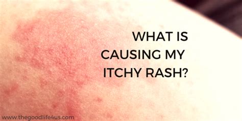 What Is Causing My Itchy Rash Thegoodlife4us