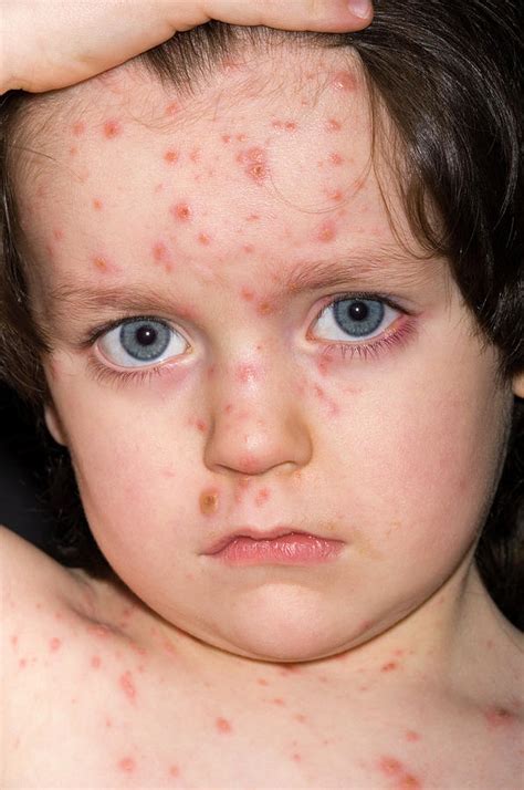 Chicken Pox Lesions On Face Photograph By Dr P Marazziscience Photo