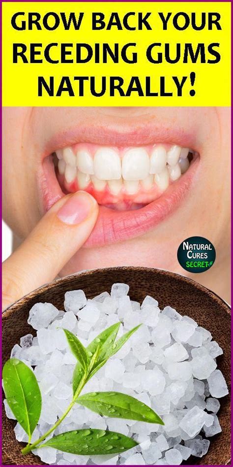 How To Treat Receding Gums Naturally At Home Gum Disease Or