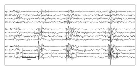 Generalized Suppression Burst Pattern In A Newborn With Early Myoclonic