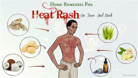36 Home Remedies For Heat Rash On Face And Neck