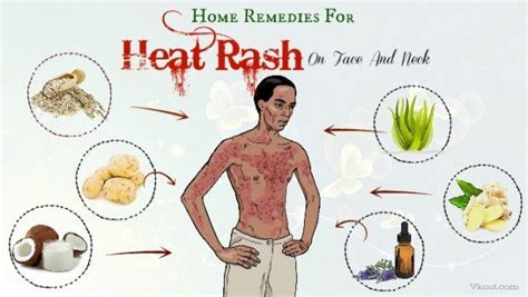 Home remedies can help control intertrigo, but medical treatment is necessary for a secondary infection of the involved skin. 36 Home Remedies For Heat Rash On Face And Neck