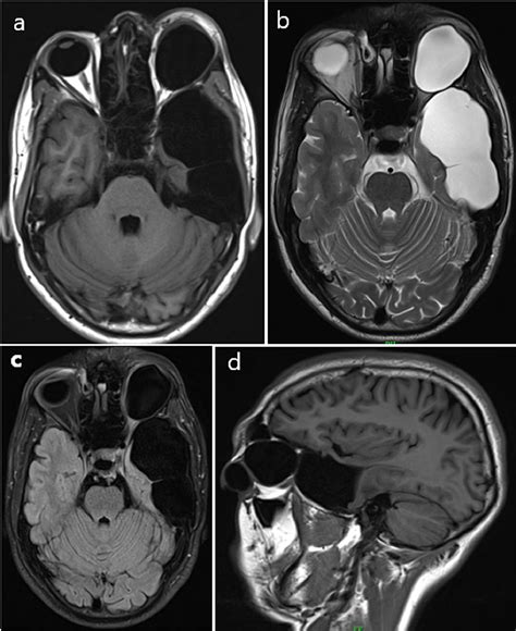 Cureus Arachnoid Cyst In Middle Cranial Fossa With Intraorbital Cyst