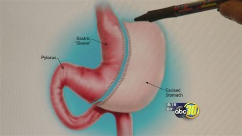 Gastric Sleeve Offering Promise To Many Weight Loss Surgery Patients