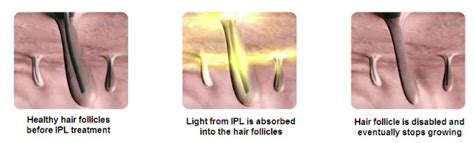 Ipl Hair Removal Products Simple And Effective Hair Removal