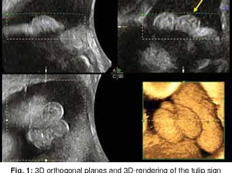 Figure 3 From 3d Vocal And Tomographic Ultrasound Imagein Prenatal