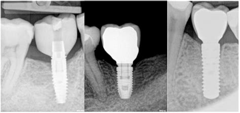 From this, 1.07 mm is comprised of the connective tissue attachment and another 0.97 mm is occupied by the junctional epithelium. Zero bone loss concepts by prof. Tomas Linkevičius. A path ...