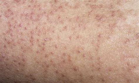 Keratosis Pilaris Chicken Skin Pictures Causes And Treatment Vlr