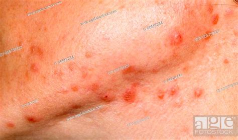 Close Up Photo Of Nodulocystic Acne On Human Skin Severe Type Of Acne