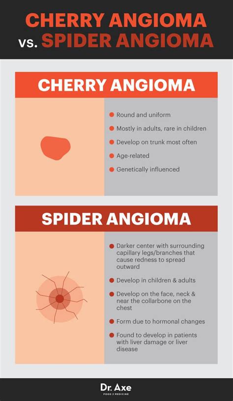 Cherry Angioma Whats Triggering This Common Skin Growth Cherry