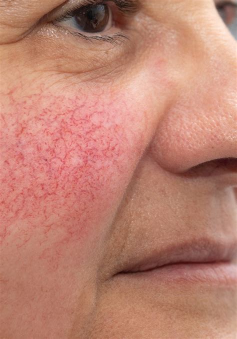 Facial Veins And Redness Laser And Skin Clinics