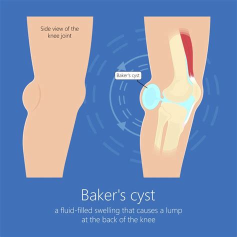 What You Need To Know About Baker S Cysts Causes Symptoms And Treatment Jeremy Burnham Md