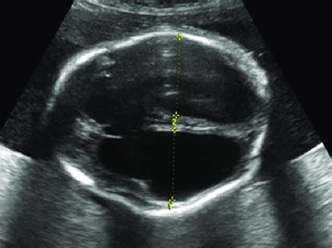 Ultrasound Image Transventricular View Of The Fetal Head Shows Severe