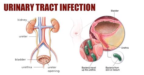 Urinary Tract Infection How To Get Rid And Prevent